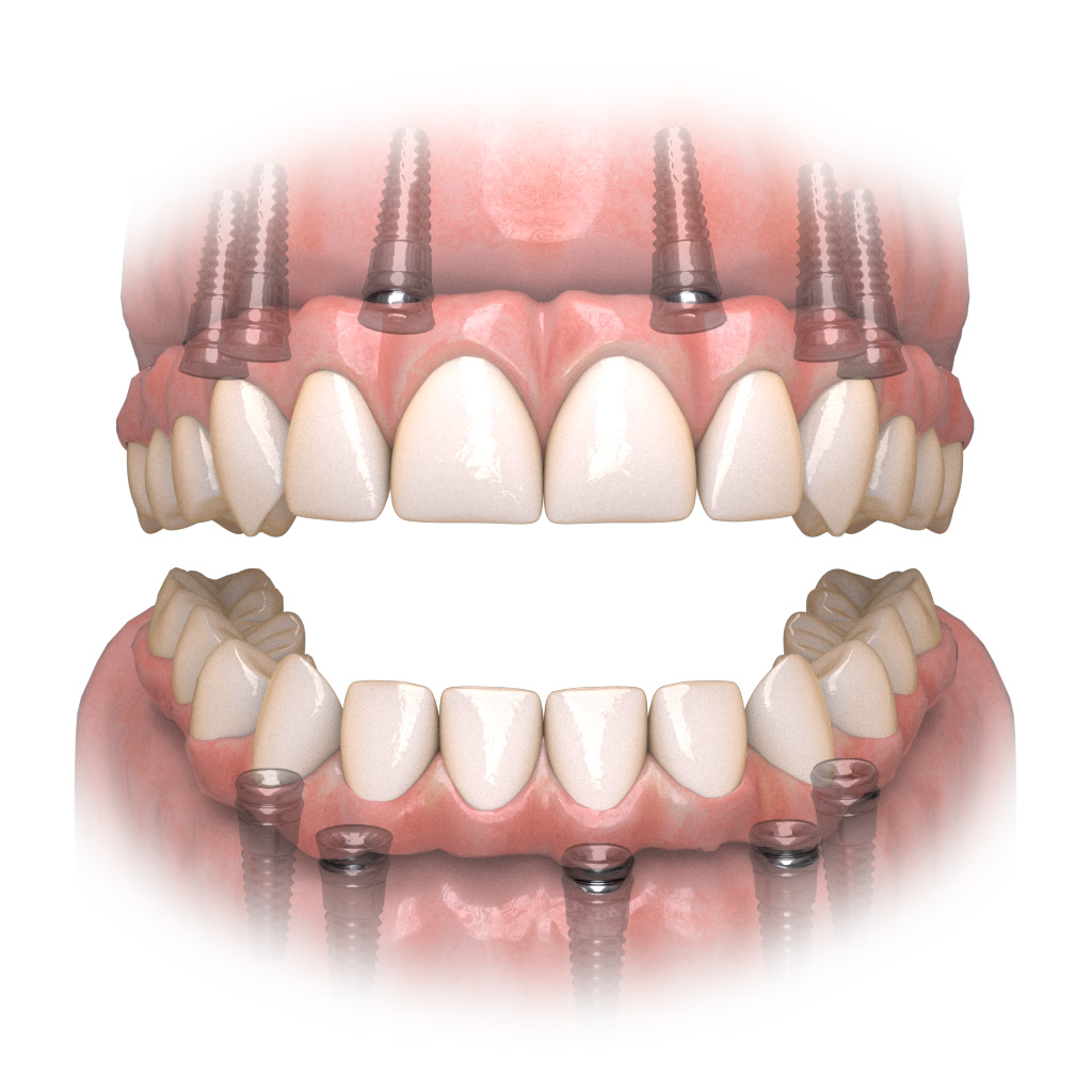 What is Hybridge Restoration?